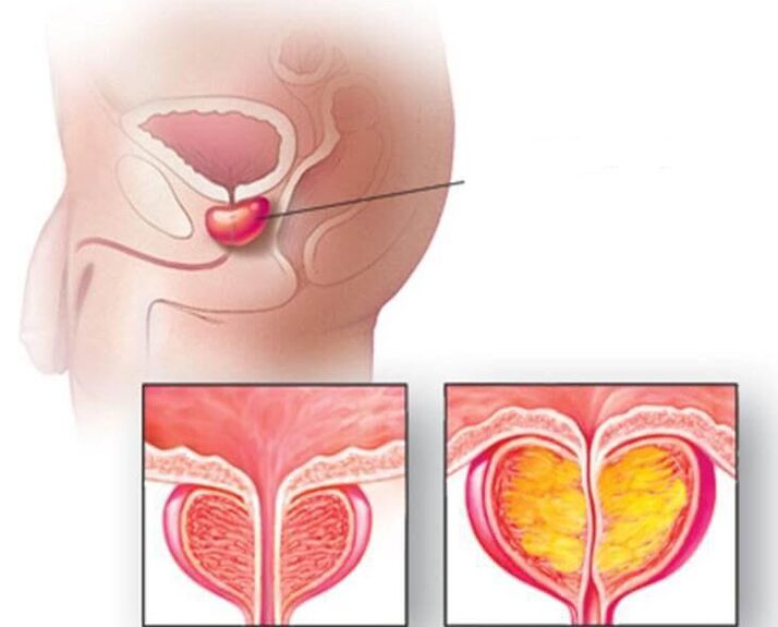 Posizione della prostata, prostata normale e ingrossata nella prostatite cronica