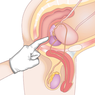 Determinazione della condizione della prostata mediante palpazione per diagnosticare la prostatite