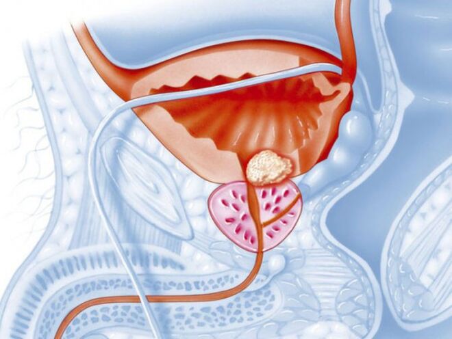 Prostatite batterica