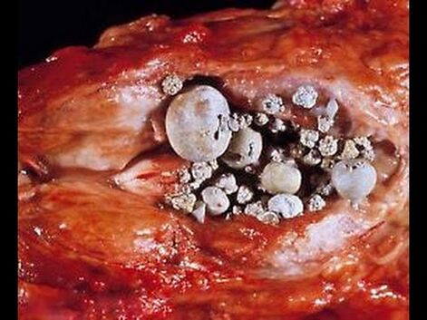 Prostatite calcarea