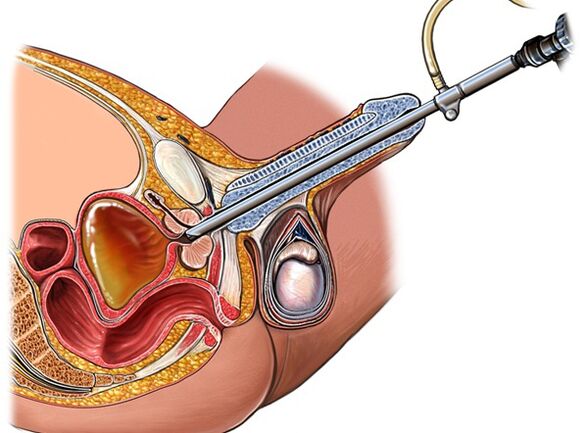 Trattamento della prostatite
