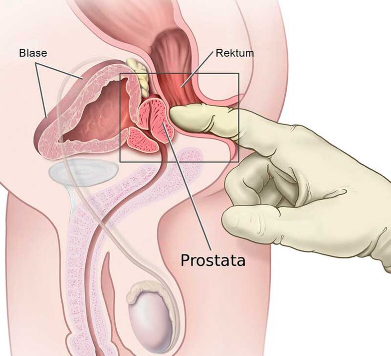 Massaggio prostatico per prostatite